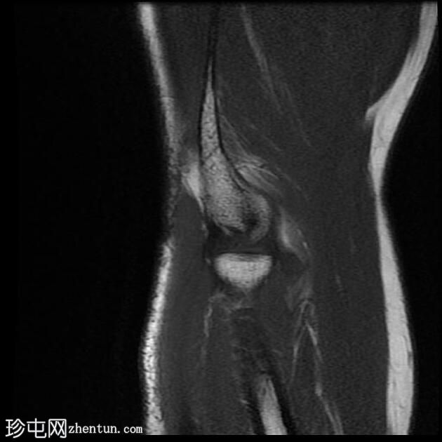 外上髁炎-网球肘