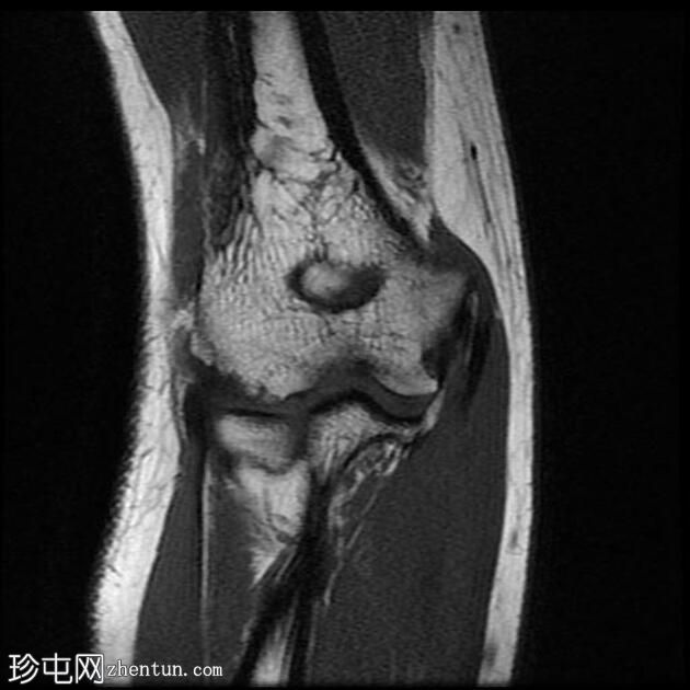 外上髁炎-网球肘