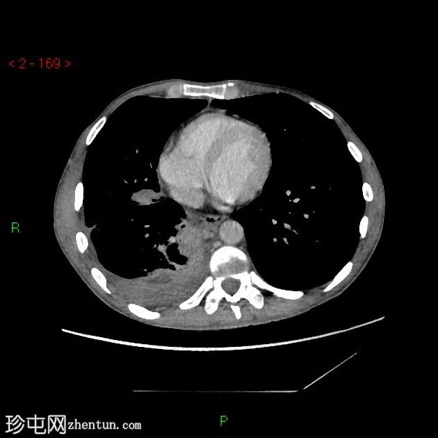 胸膜放射菌病