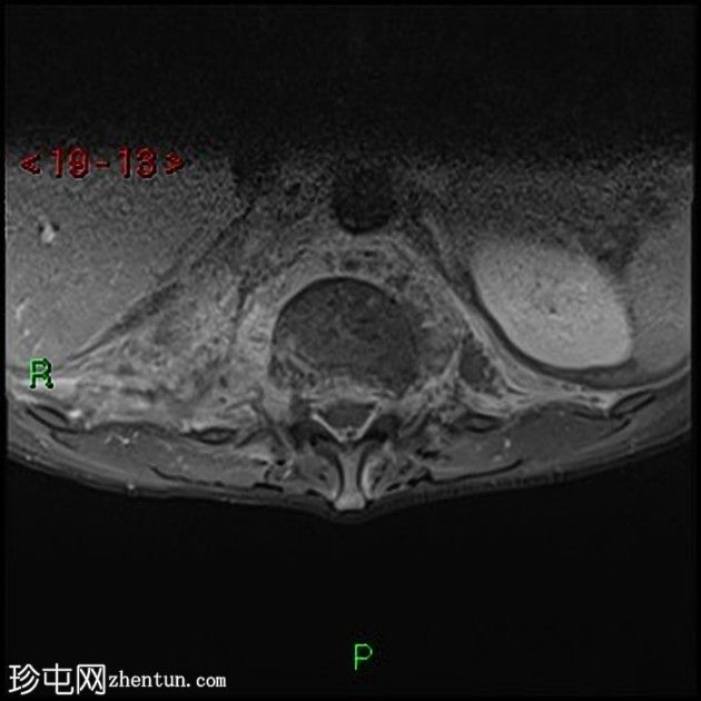 胸膜放射菌病