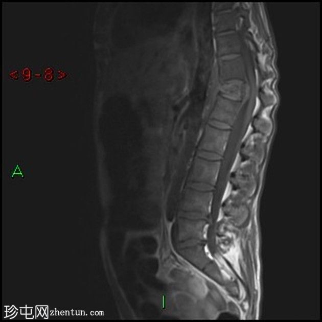 胸膜放射菌病