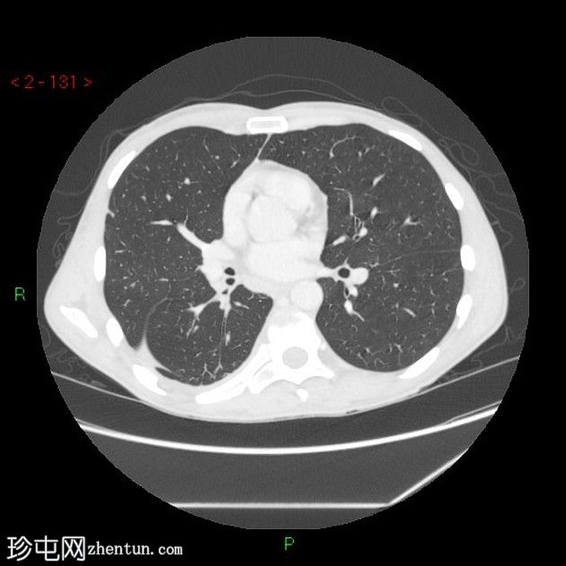 胸膜放射菌病