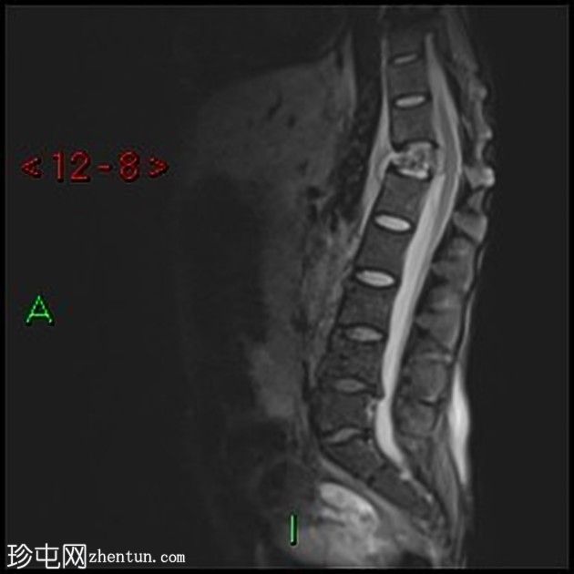 胸膜放射菌病