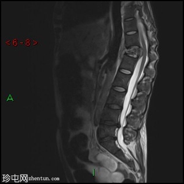 胸膜放射菌病