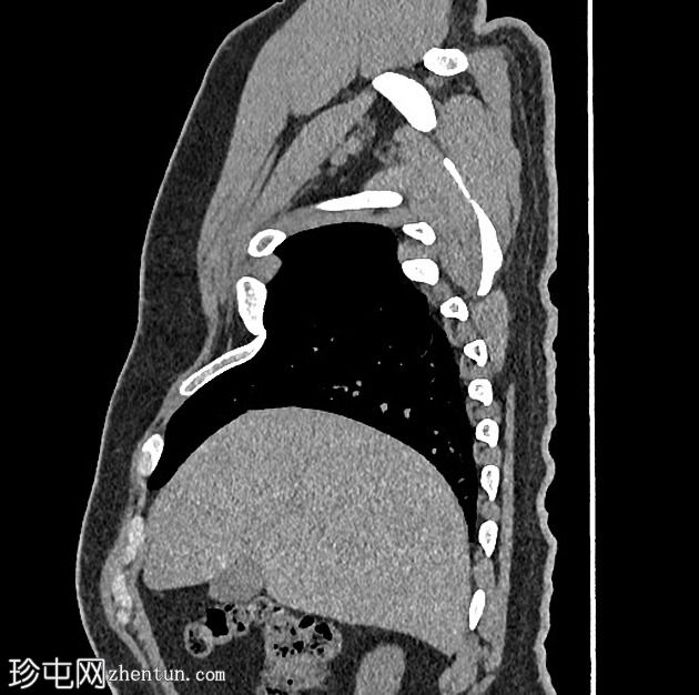 肋骨假关节