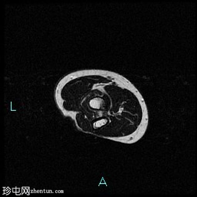 伴二头肌腱远端慢性部分断裂的肌腱病