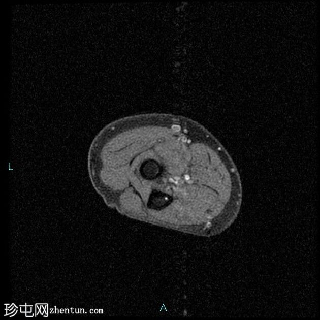 伴二头肌腱远端慢性部分断裂的肌腱病