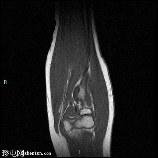 伴二头肌腱远端慢性部分断裂的肌腱病