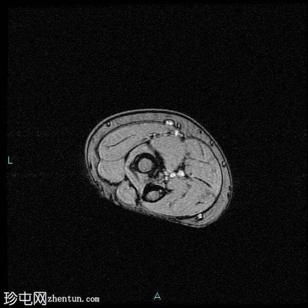 伴二头肌腱远端慢性部分断裂的肌腱病