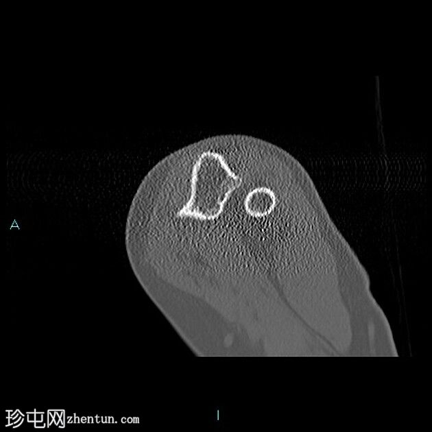 伴二头肌腱远端慢性部分断裂的肌腱病