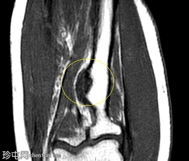 伴二头肌腱远端慢性部分断裂的肌腱病
