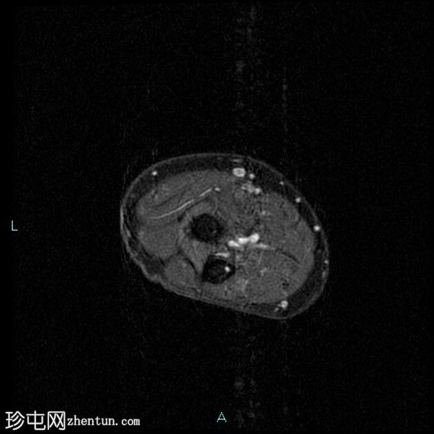 伴二头肌腱远端慢性部分断裂的肌腱病