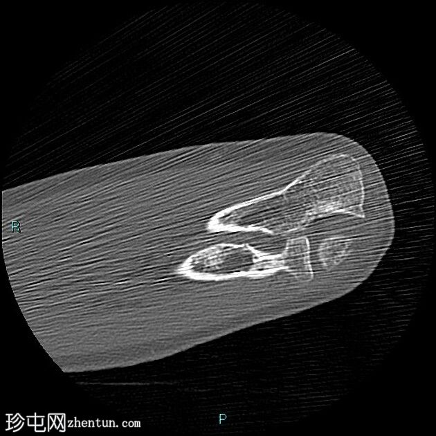 伴二头肌腱远端慢性部分断裂的肌腱病