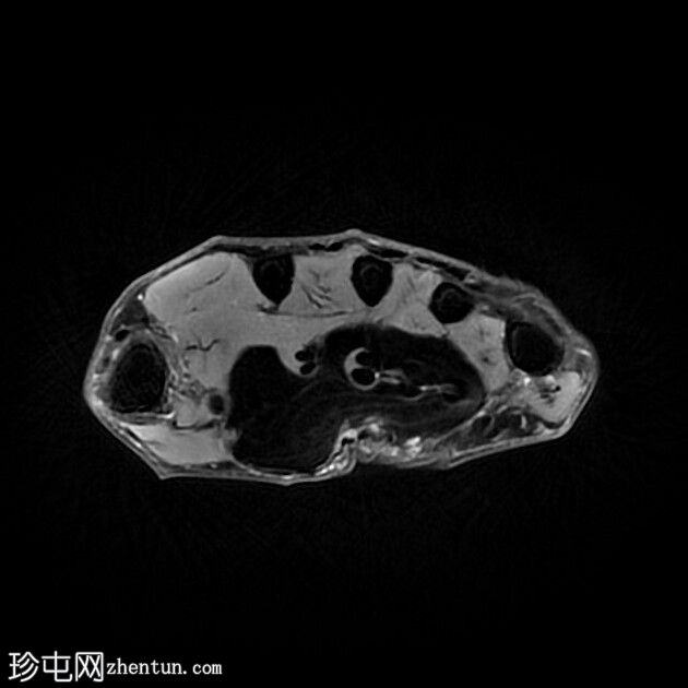 巨大脂肪瘤-右手