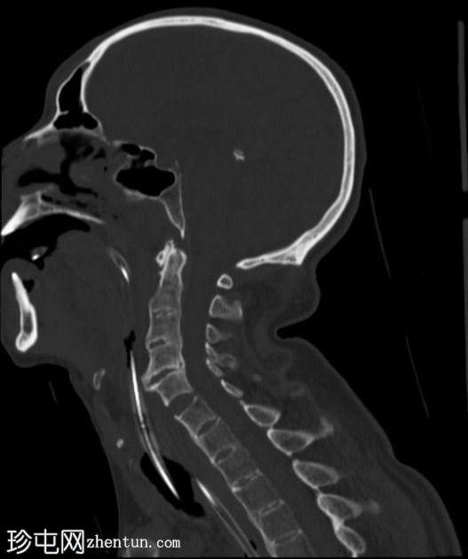 颈椎骨折-强直性脊柱炎