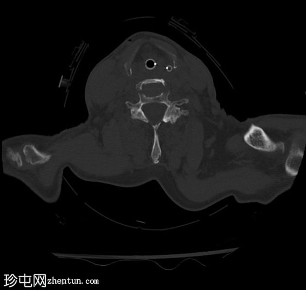 颈椎骨折-强直性脊柱炎