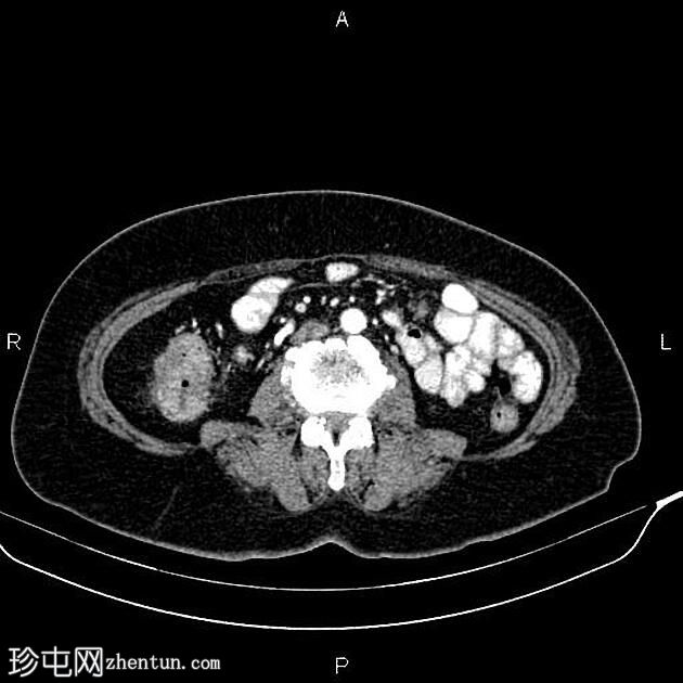 升结肠腺癌