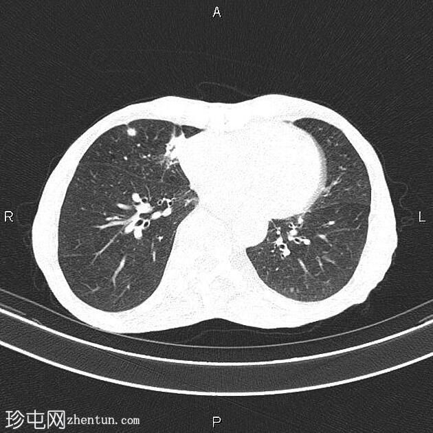 食管远端鳞状细胞癌