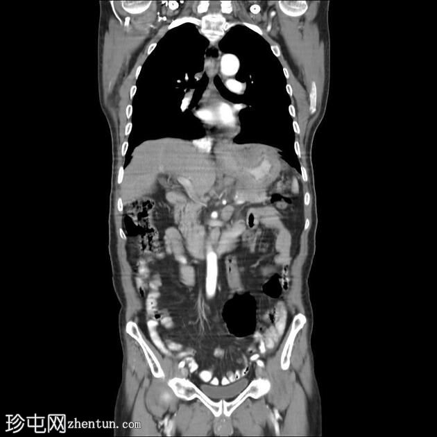 胃癌延伸至胃食管交界处