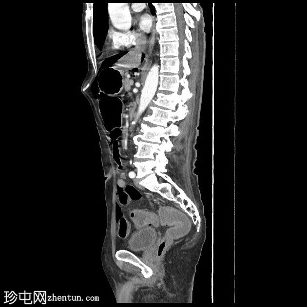 传染性结肠炎背景下的张力性气腹