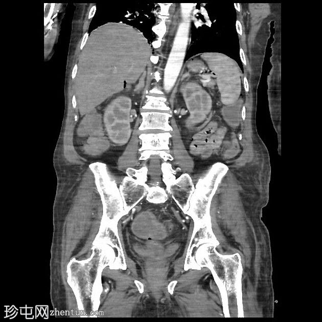 传染性结肠炎背景下的张力性气腹