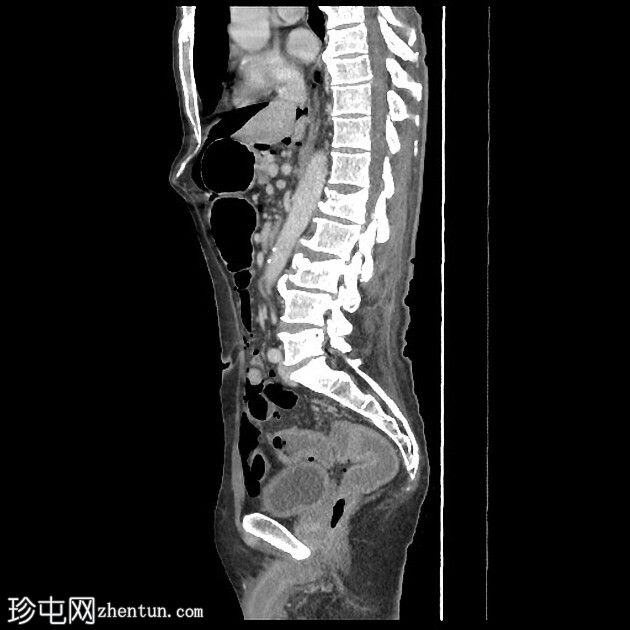 传染性结肠炎背景下的张力性气腹