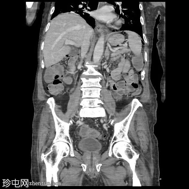 传染性结肠炎背景下的张力性气腹