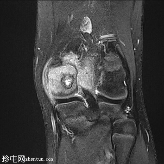成软骨细胞瘤