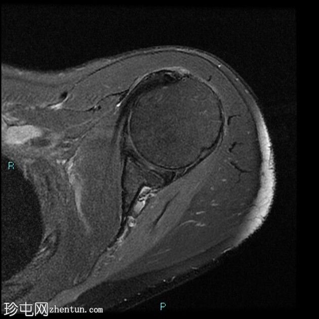 肩胛上及棘突旁巨大切迹囊肿伴肩胛上神经病变