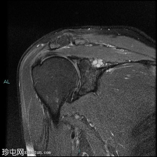 肩胛上及棘突旁巨大切迹囊肿伴肩胛上神经病变