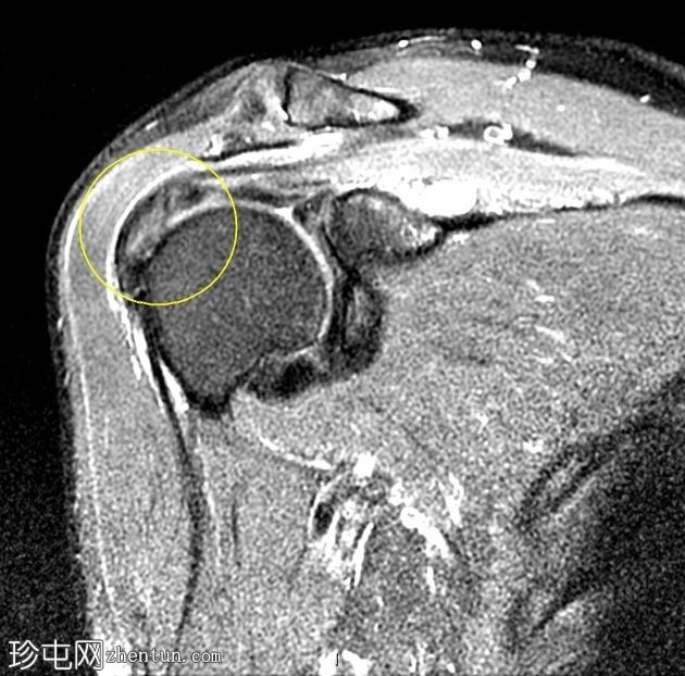 肩胛上及棘突旁巨大切迹囊肿伴肩胛上神经病变