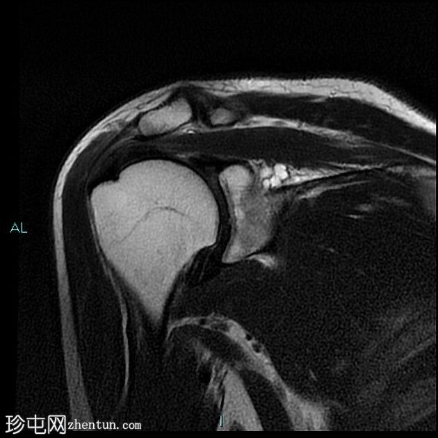 肩胛上及棘突旁巨大切迹囊肿伴肩胛上神经病变