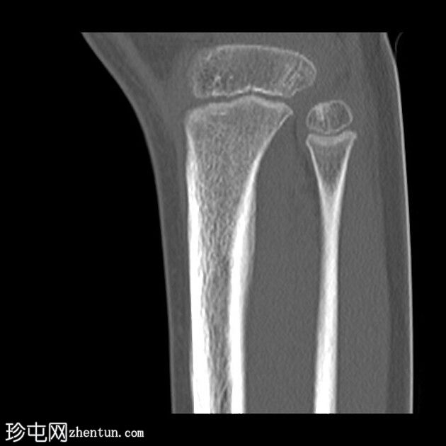 胫骨应力性骨折