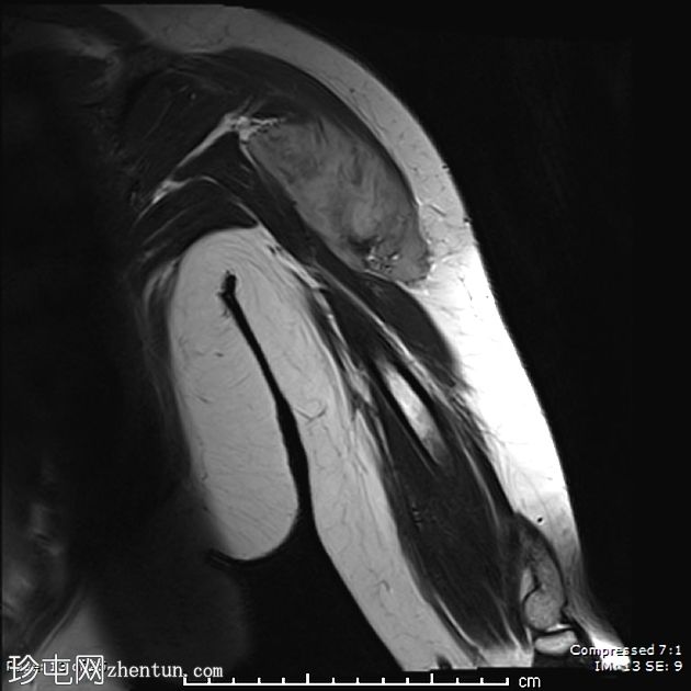 腹外硬纤维瘤-肩部