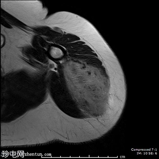 腹外硬纤维瘤-肩部