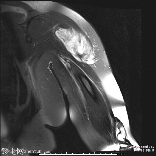 腹外硬纤维瘤-肩部