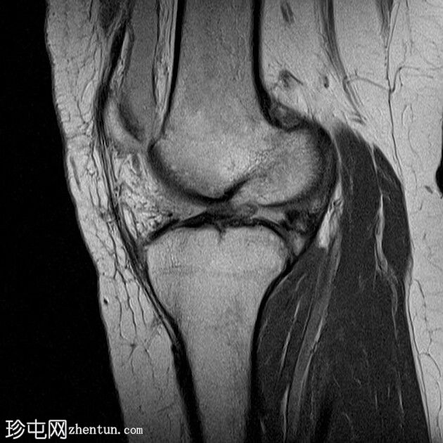 前交叉韧带缺损与慢性内侧副韧带断裂