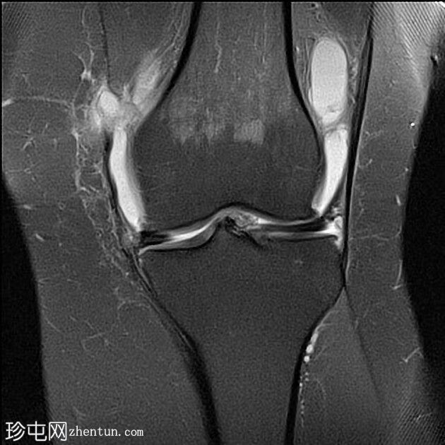 前交叉韧带缺损与慢性内侧副韧带断裂