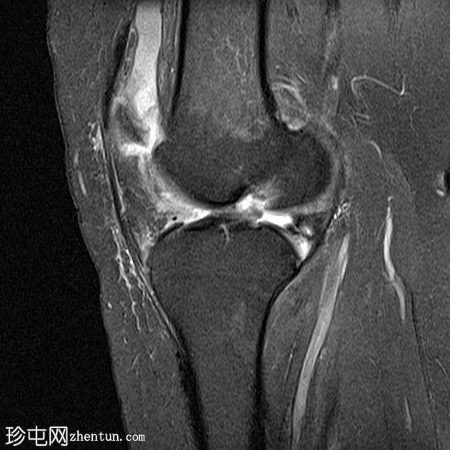 前交叉韧带缺损与慢性内侧副韧带断裂