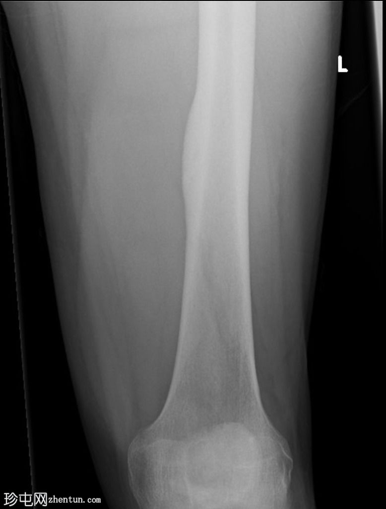 股骨骨样骨瘤