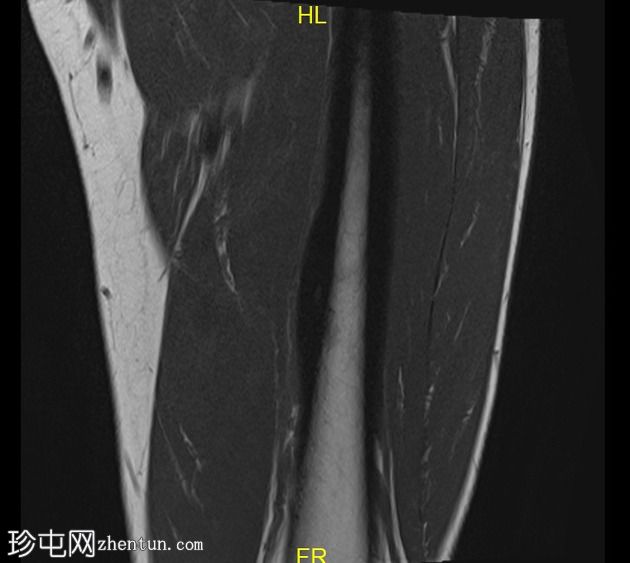 股骨骨样骨瘤