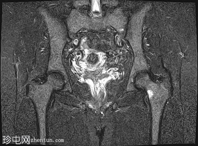 应力性骨折-股骨颈