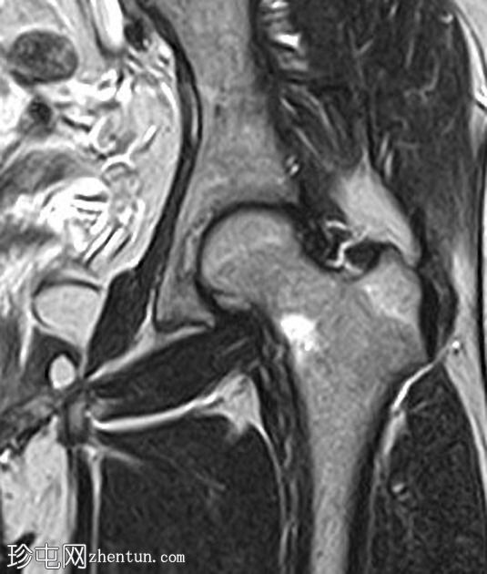 应力性骨折-股骨颈