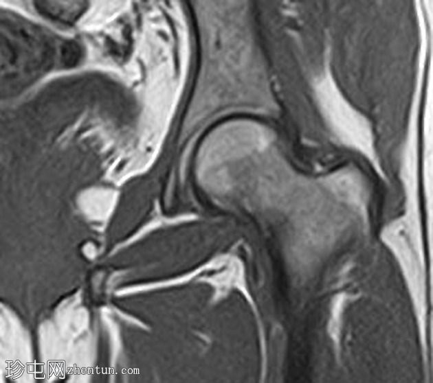 应力性骨折-股骨颈