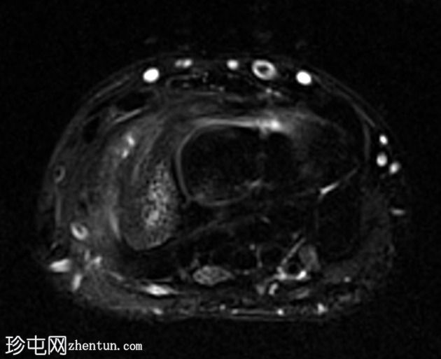 舟状骨骨折和缺血性坏死（MR 灌注）