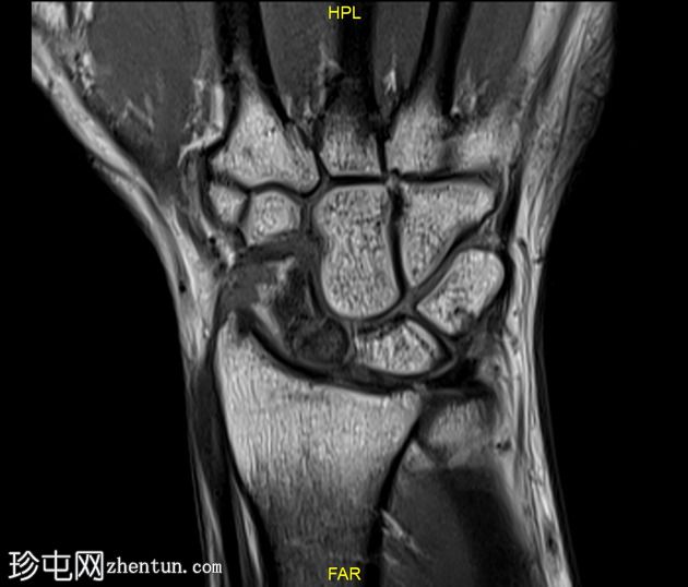 舟状骨骨折和缺血性坏死（MR 灌注）