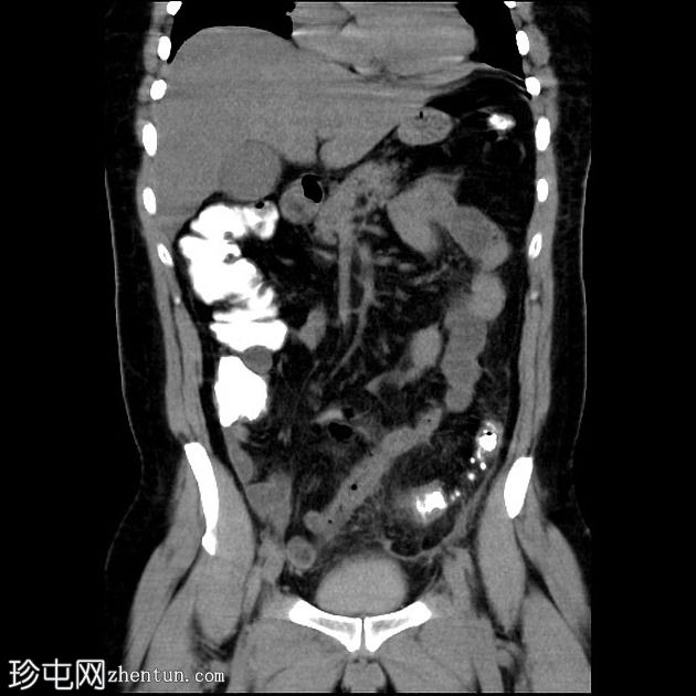 结肠憩室炎进展为憩室脓肿