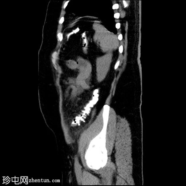 结肠憩室炎进展为憩室脓肿