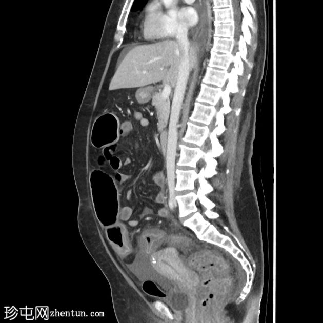 难辨梭菌结肠炎