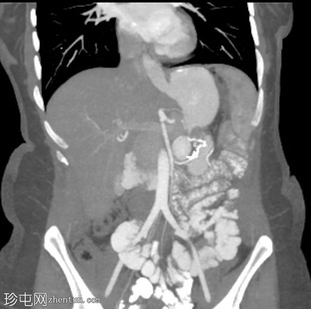 腹腔镜袖状胃切除术后胃扭转